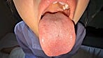 【個人撮影】谷田かりなの舌ブラシで「汚舌苔」採取 2