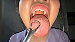 【個人撮影】谷田かりなの舌ブラシで「汚舌苔」採取 6