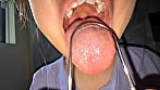 【個人撮影】谷田かりなの舌ブラシで「汚舌苔」採取 9