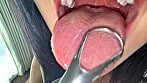 【個人撮影】桃瀬まゆの舌ブラシで「汚舌苔」採取 8